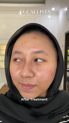 Callista Skin Treatment - Cimanggu